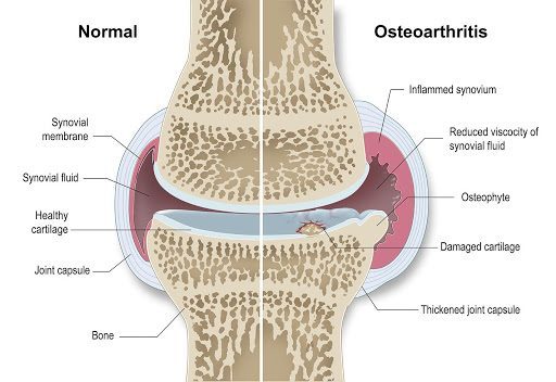 Normal vs OA joint